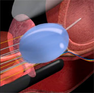 淺談前列腺(攝護腺)癌之新療法    氬氦刀冷凍治療手術(相關圖片)