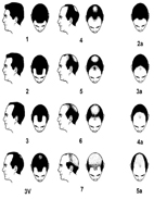 男性禿頭的煩惱(相關圖片)