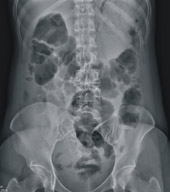 老人便秘知多少(相關圖片)