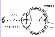 淺談飛蚊症(相關圖片)
