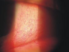 如何讓眼睛不再乾澀  介紹乾眼症(相關圖片)