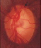 認識「青光眼」(相關圖片)