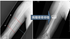 關於骨腫瘤治療新進展(相關圖片)