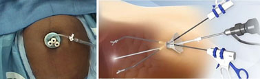 微創手術再進化   傷口要「小」更要「少」  您不可不知的『單孔』腹腔鏡手術(相關圖片)