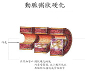 天氣冷颼颼  腦中風預防與治療(相關圖片)