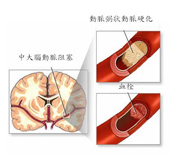 天氣冷颼颼  腦中風預防與治療(相關圖片)