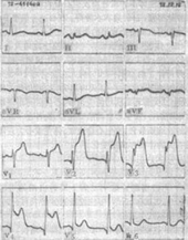 天冷如何預防 心肌梗塞與其他心血管疾病發作(相關圖片)