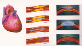天冷如何預防 心肌梗塞與其他心血管疾病發作(相關圖片)