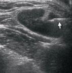 耳鼻喉科軟組織超音波檢查的過去、現在與未來(相關圖片)