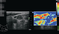 耳鼻喉科軟組織超音波檢查的過去、現在與未來(相關圖片)
