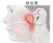 小兒耳鼻喉的常見疾病(相關圖片)
