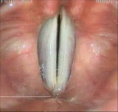 喉顯微手術簡介(相關圖片)