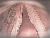 喉顯微手術簡介(相關圖片)