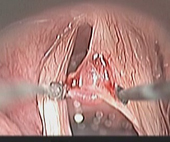 喉顯微手術簡介(相關圖片)