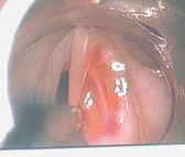 喉顯微手術簡介(相關圖片)