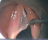 喉顯微手術簡介(相關圖片)