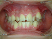 『齒顎矯正』讓你笑得更有自信(相關圖片)