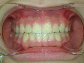 『齒顎矯正』讓你笑得更有自信(相關圖片)