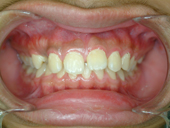 『齒顎矯正』讓你笑得更有自信(相關圖片)