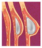 找回遺失的溫柔  談乳房重建(相關圖片)