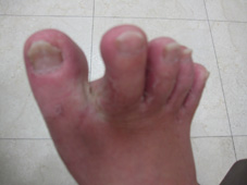 夏季常見的皮膚疾病(相關圖片)