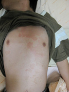 夏季常見的皮膚疾病(相關圖片)