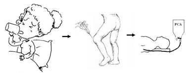 無痛及股四頭肌保留法之人工膝關節置換術(相關圖片)