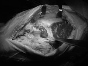 無痛及股四頭肌保留法之人工膝關節置換術(相關圖片)