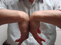 腕隧道症候群(相關圖片)