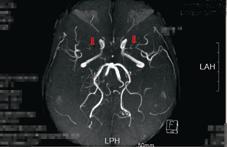 年輕型中風  毛毛樣血管病變(相關圖片)