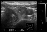 現代頭頸外科手術的神經守護『神經偵測儀』(相關圖片)