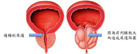 尿尿鎖不住！ 談『攝護腺』疾病(相關圖片)