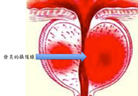 尿尿鎖不住！ 談『攝護腺』疾病(相關圖片)