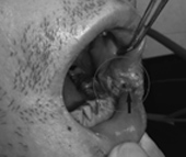 檳榔和吸菸會得『口腔癌』嗎？(相關圖片)