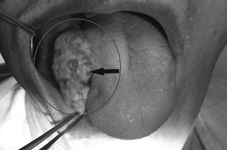 檳榔和吸菸會得『口腔癌』嗎？(相關圖片)