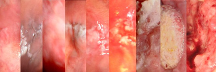 檳榔和吸菸會得『口腔癌』嗎？(相關圖片)