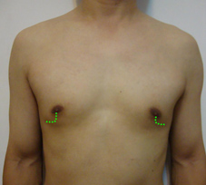 水的力量  以水刀抽脂治療『男性女乳症』(相關圖片)