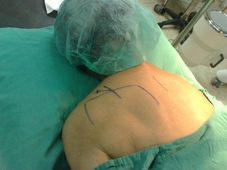 疼痛簡介及疼痛治療的新武器  『高頻熱凝療法』(相關圖片)