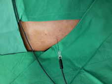 疼痛簡介及疼痛治療的新武器  『高頻熱凝療法』(相關圖片)