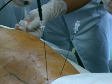 疼痛簡介及疼痛治療的新武器  『高頻熱凝療法』(相關圖片)