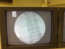 疼痛簡介及疼痛治療的新武器  『高頻熱凝療法』(相關圖片)