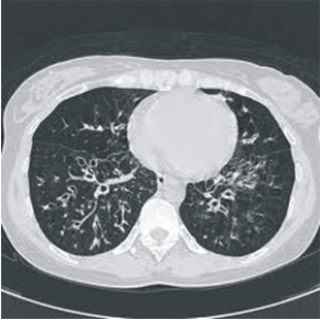 我不是林黛玉，為何卻咳血   淺談咳血的處置原則(相關圖片)