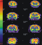 認識失智症  如何及早發現(相關圖片)