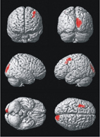 認識失智症  如何及早發現(相關圖片)