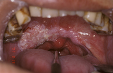   腭癌手術病人合作的成功案例(相關圖片)