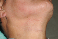   腭癌手術病人合作的成功案例(相關圖片)