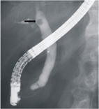 結石滯塞了 談『膽道結石』(相關圖片)