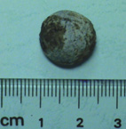 結石滯塞了 談『膽道結石』(相關圖片)