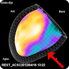 核醫在『心血管疾病』的應用(相關圖片)