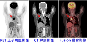 『正子檢查在腫瘤』的應用(相關圖片)